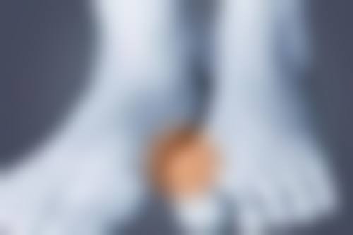 二、拉双眼皮修复阶段的关键节点