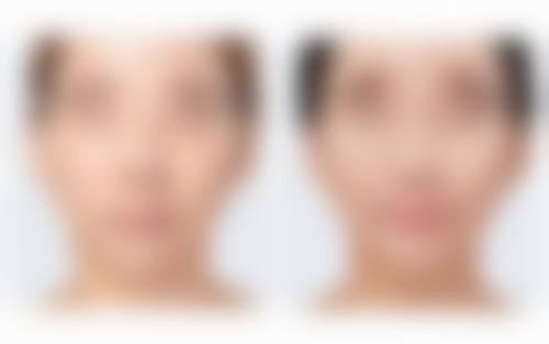 四、自体耳软骨隆鼻修复的特别提示