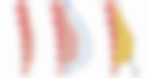 一、无创双眼皮的常见方法