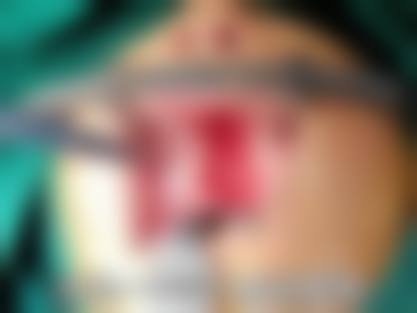 一、成都easySCULPT怡脂整形正规吗?