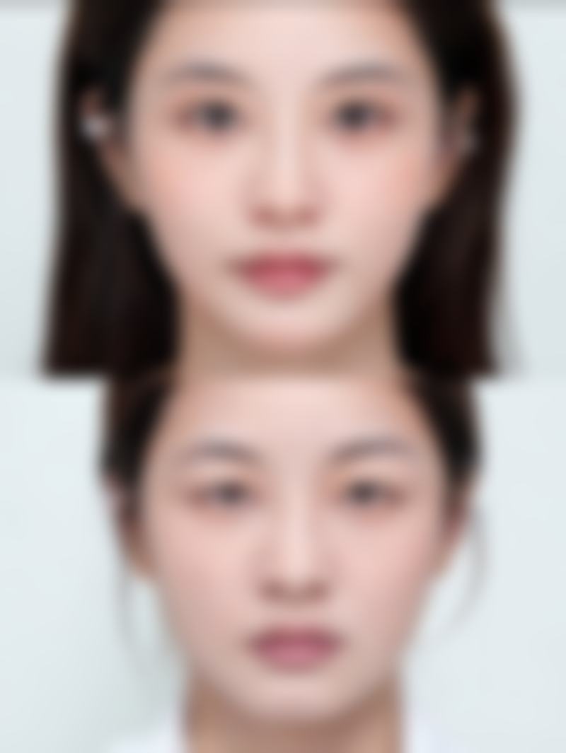 无创双眼皮怎么做的？常见方法、美学设计及风险全解析，附相关视频参考 