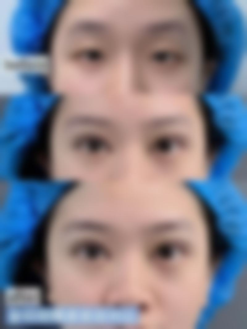 拉双眼皮多久能好啊？恢复时间受手术方式、体质和护理影响全揭秘！ 