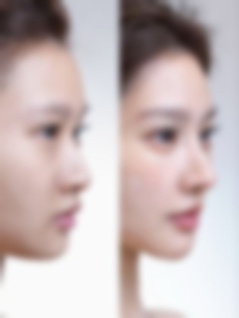 双眼皮三点定位和全切哪个好一点？总结来说