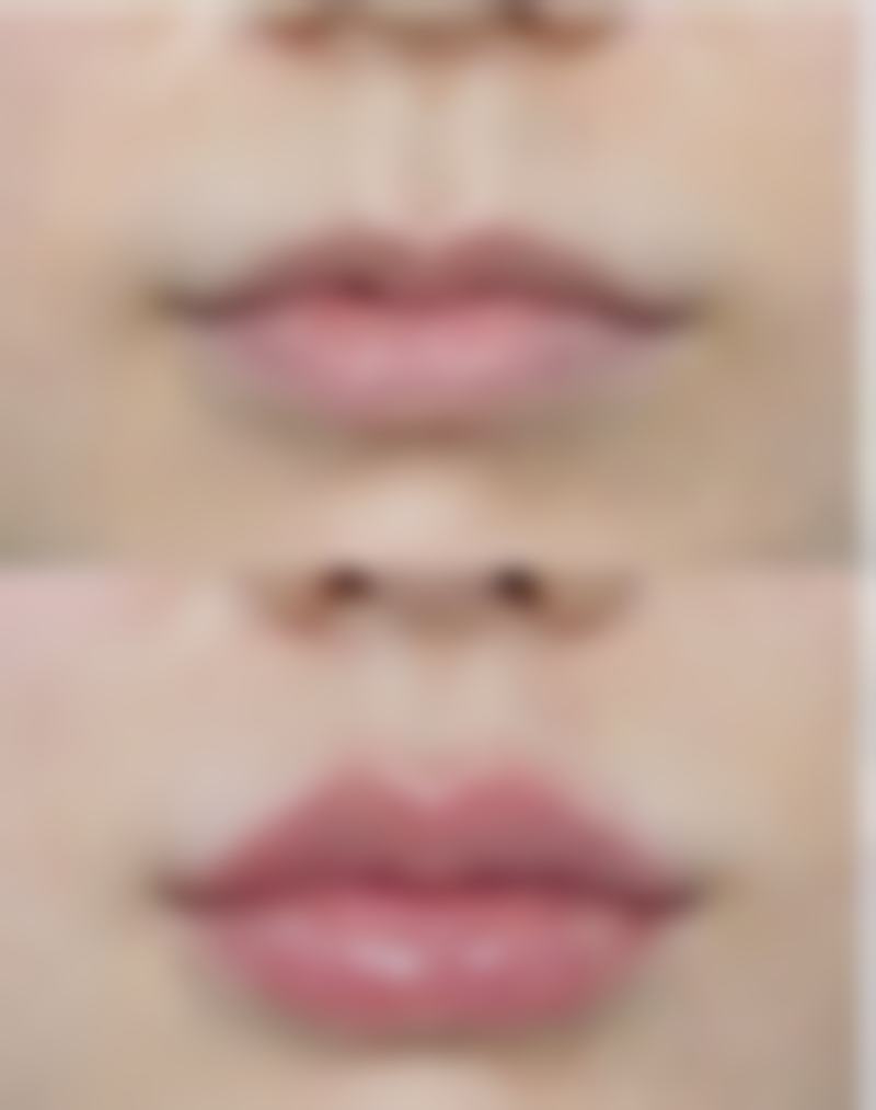 一、抽脂后消肿时间的影响因素