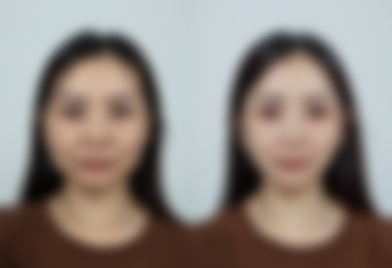 四、隆鼻修复期不同阶段的日常活动与护理重点