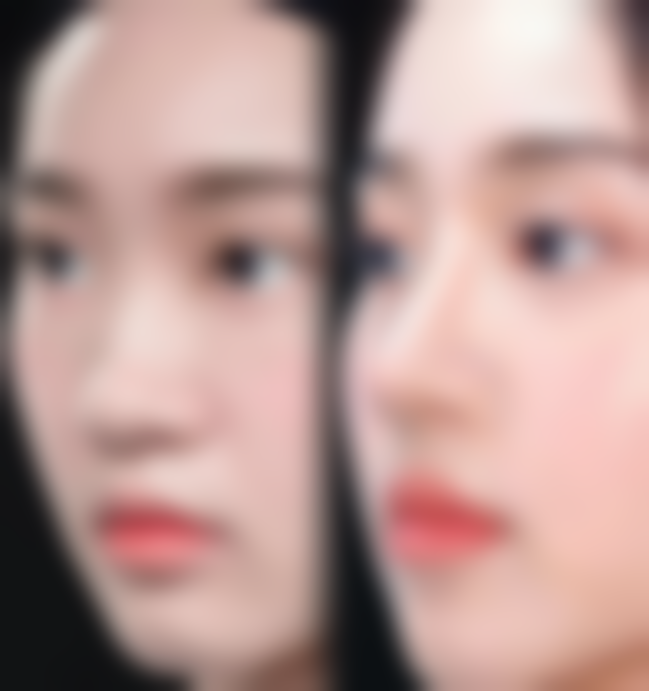 三、如何判断是否需要取出隆胸假体