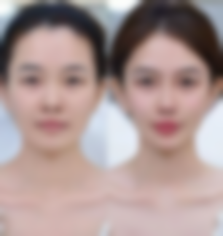 二、无创双眼皮的美学设计要点