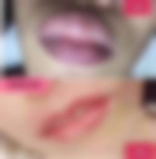 眼袋外切手术后青的什么时候能消除？了解恢复时间与护理要点加快消退