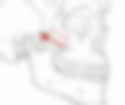 一、丰太阳穴用什么填充好之玻尿酸填充