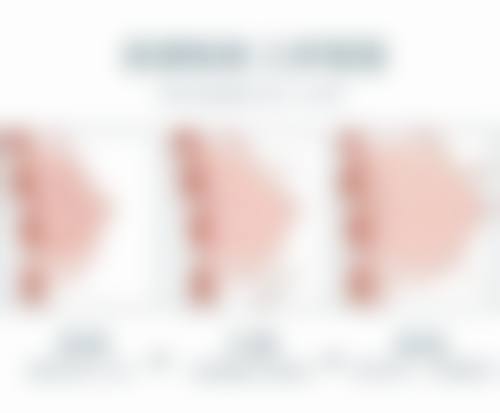 全切双眼皮眼袋肿正常吗？多久消肿？术后恢复与护理要点大揭秘！ 