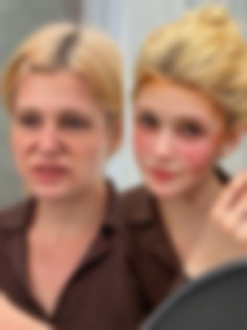 一、全切双眼皮眼袋肿正常吗