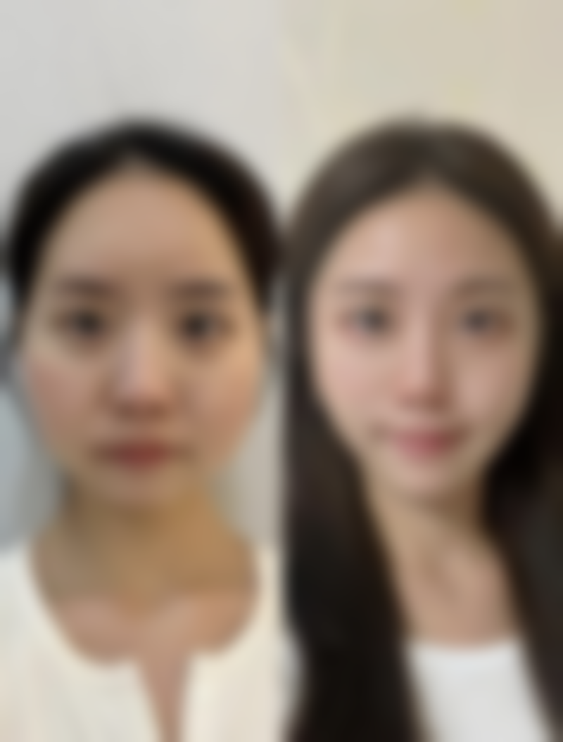 二、怎样判断双眼皮割的深不深之修复情况判断