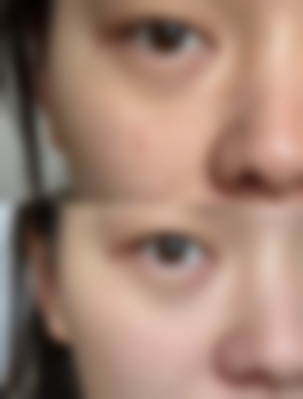 六、怎样判断双眼皮割的深不深之后续建议