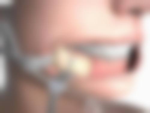 一、大综合隆鼻概述