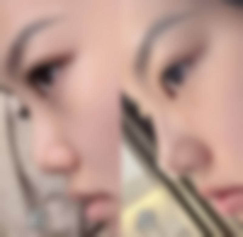 五、去除疤痕疙瘩所需费用