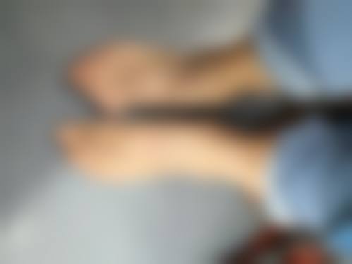 二、腿抽脂有什么危害之其他潜在风险