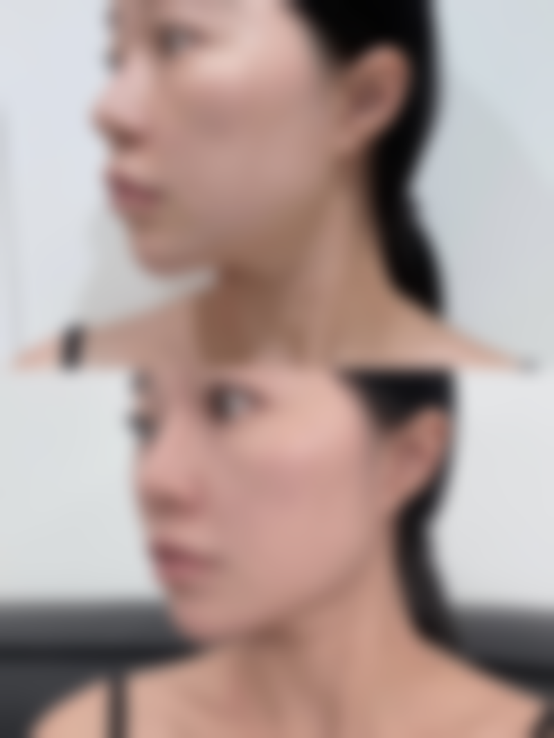 四、理性看待耳软骨隆鼻的“保质期”