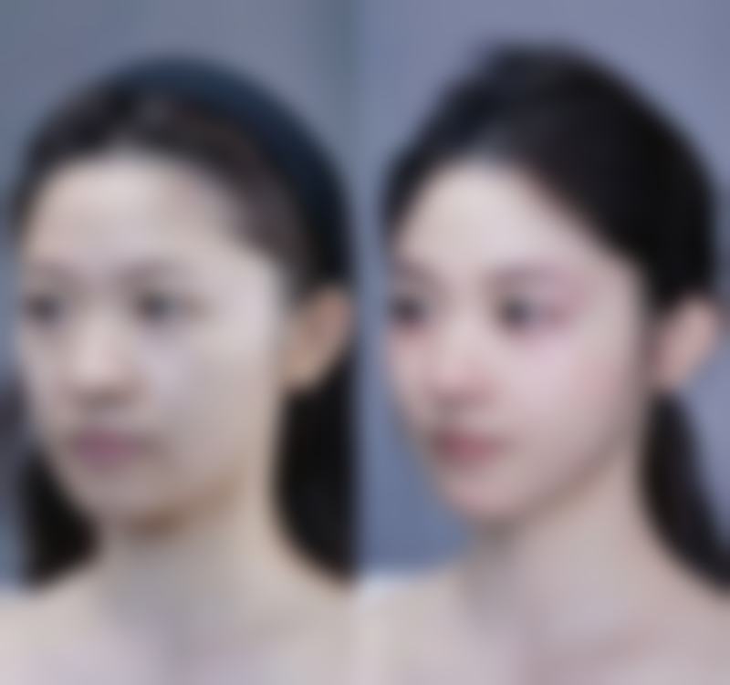 三、影响拆线的其他因素