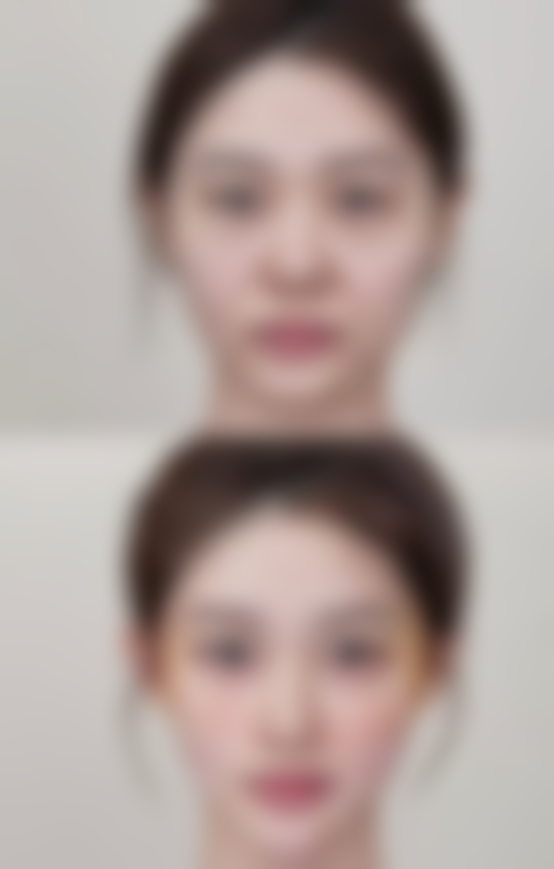 六、总结：正确看待眼袋问题