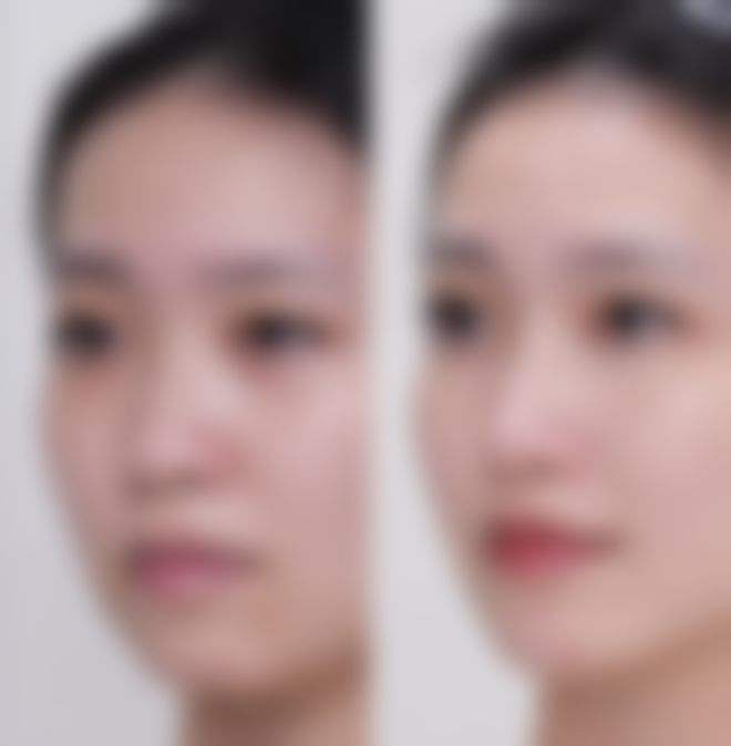 一、去眼袋手术常见方式