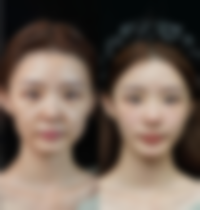 耳软骨隆鼻尖能一辈子吗？解析维持时间影响因素及延长效果秘诀