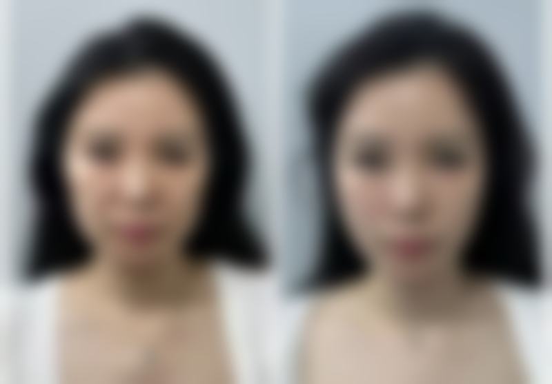 去眼袋还要拆线吗？不同手术方式拆线情况大揭秘，附详细对比图片 