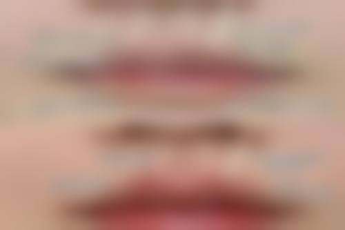 四、激光治疤痕的美学改善潜力与局限性