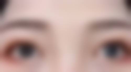 五、做双眼皮去美容院可以吗？失败修复有办法