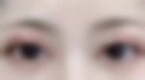 一、做双眼皮去美容院可以吗？先了解手术性质