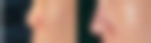 一、激光治疤痕的有效原理大揭秘