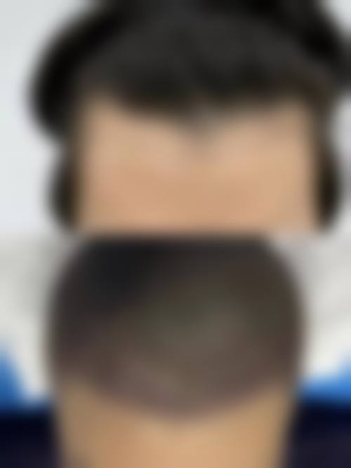 五、苏州维秘医疗美容诊所植发科价格表