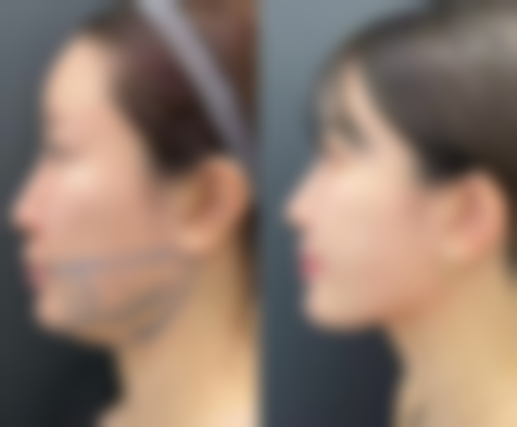 二、瘦脸针打完需要注意的不同时间阶段护理重点