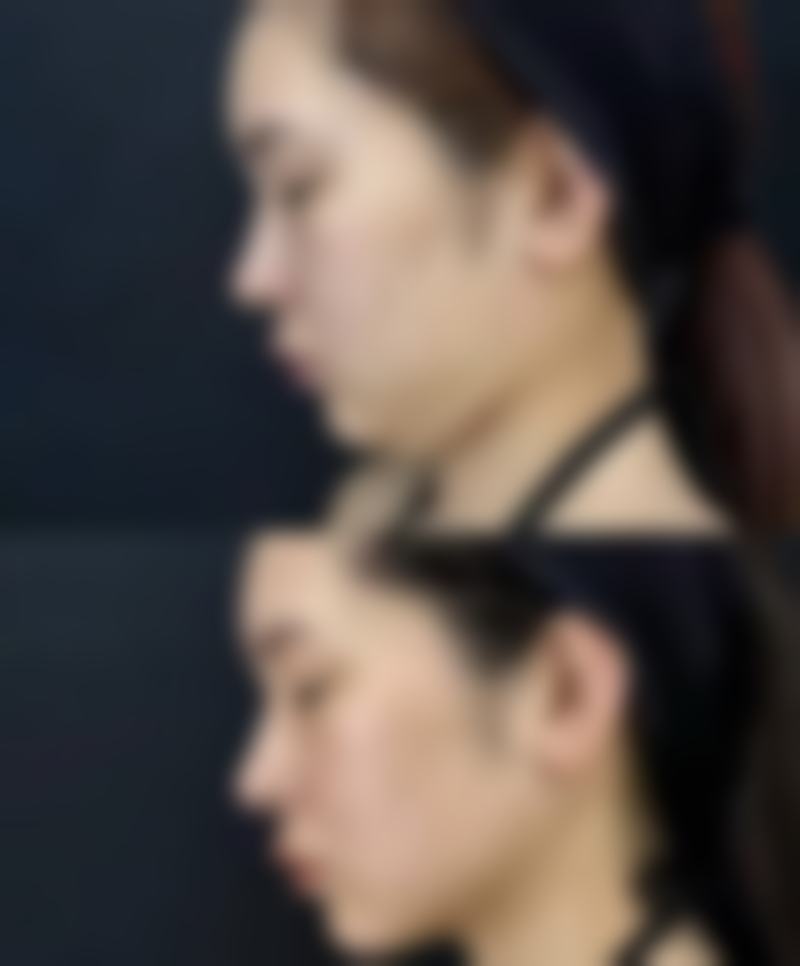 隆鼻能保持一辈子吗？了解不同材料维持时间、影响因素及美学建议！ 