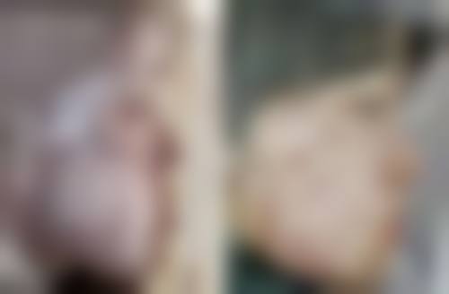 五、腹部吸脂后消肿异常情况的处理