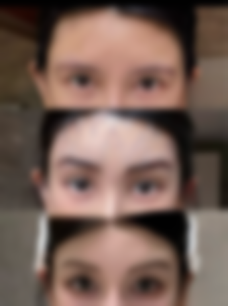 一、泪沟和眼袋的形成原因