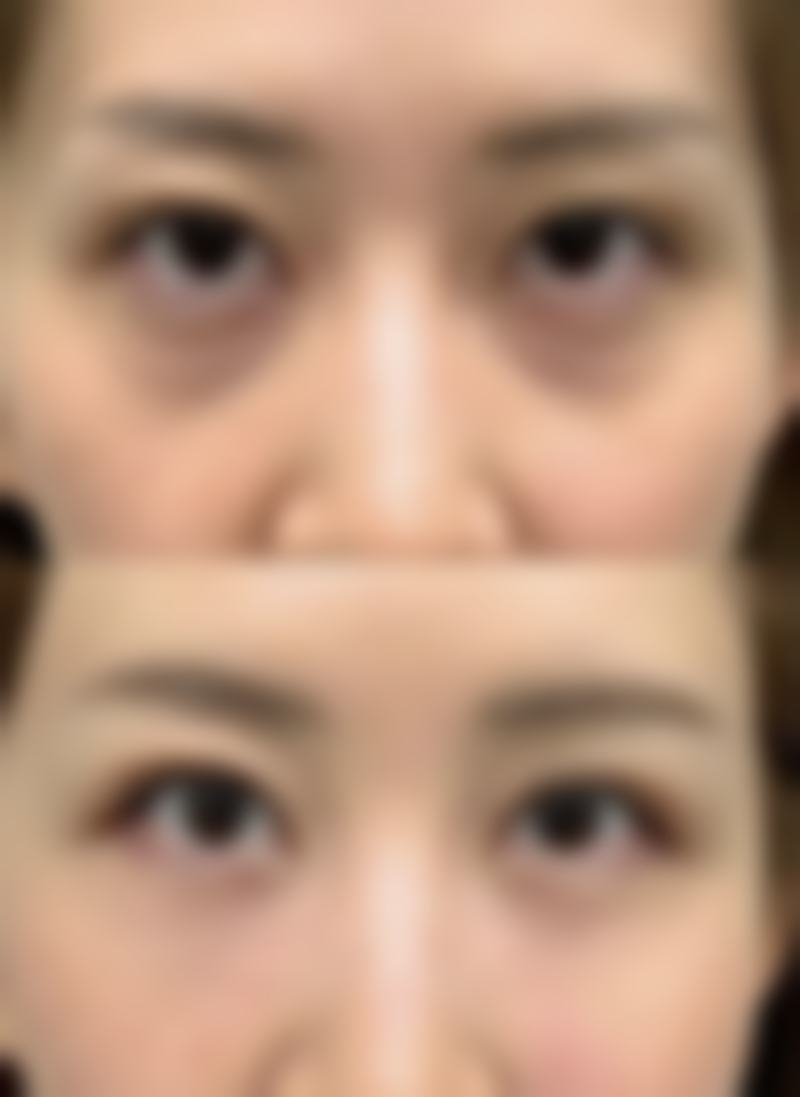 五、疤痕修复期间的注意事项