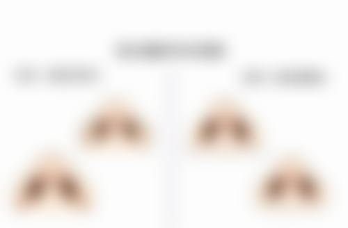 四、隆鼻子选鼻型，基础条件要评估