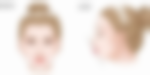 五、全切双眼皮增生相关常见问题解答