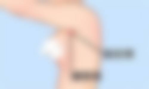 四、割双眼皮修复期可能出现的问题及应对方法