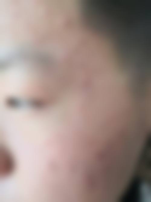 四、佳木斯科学大学附属第一医院皮肤科特色项目