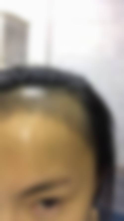 五、杭州碧莲盛无痕植发整形医院价格表