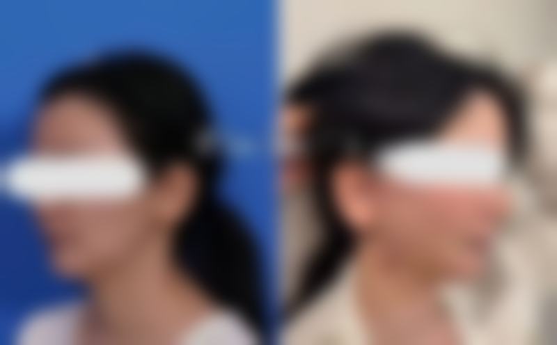 三、影响打保妥适瘦脸针费用的因素