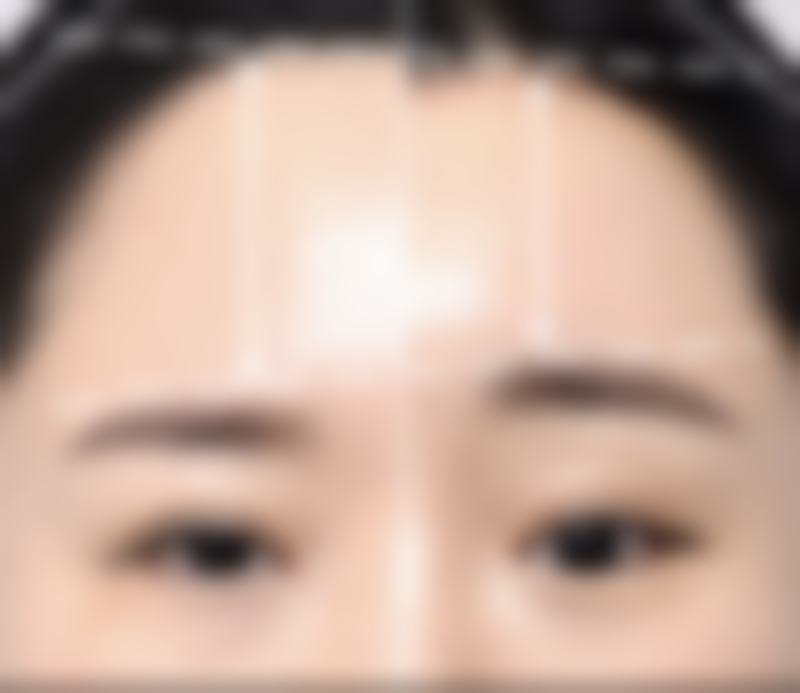 一、全切双眼皮增生重度的常见原因