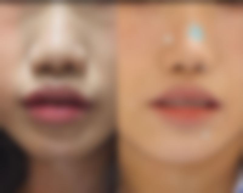 一、隆鼻子选鼻型，审美标准特别重要