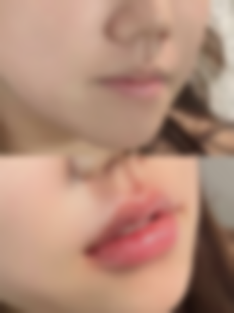 六、如何选择合适的玻尿酸隆胸方案