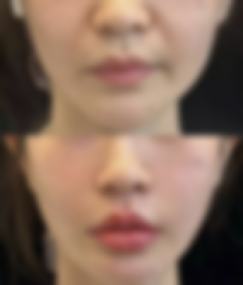 一、割双眼皮修复时间的影响因素