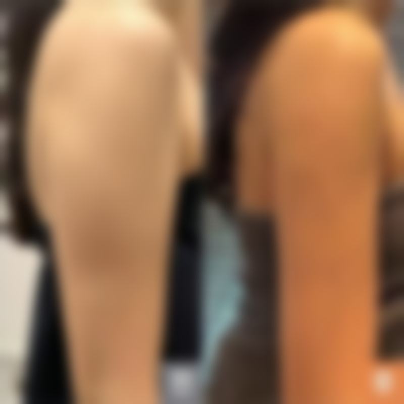 面部抽脂的副作用有哪些？了解潜在危害，助你理性选择面部抽脂手术 