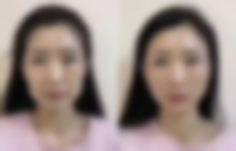 二、隆鼻子选鼻型，材料选择有影响