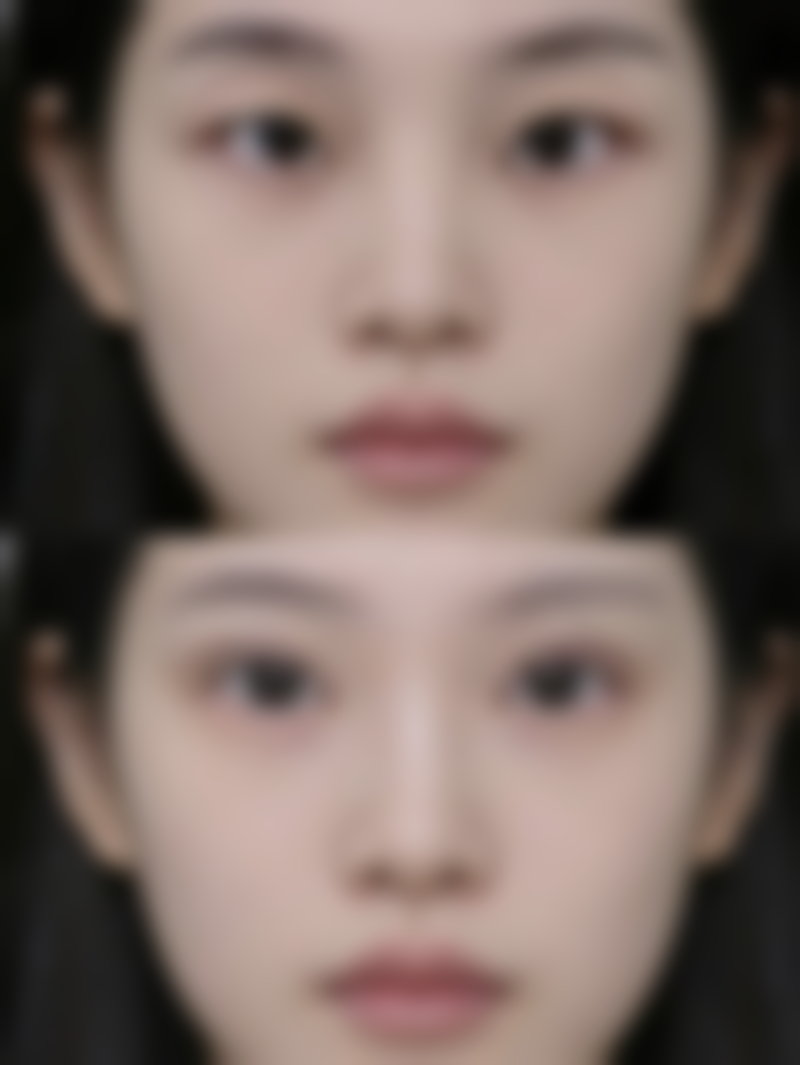 二、吸脂祛眼袋的成效