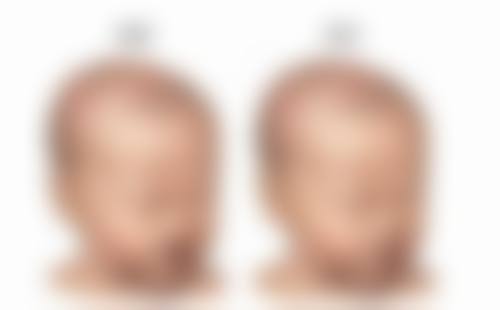 五、如何选择合适的隆鼻方式